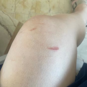 Ladyboss Güzellik Salonu Lazer Seansı Sonrası Bacaklarımda Yanıklar Oluştu