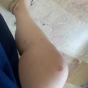 Ladyboss Güzellik Salonu Lazer Seansı Sonrası Bacaklarımda Yanıklar Oluştu