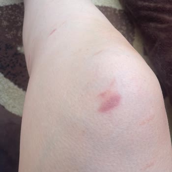 Ladyboss Güzellik Salonu Lazer Seansı Sonrası Bacaklarımda Yanıklar Oluştu