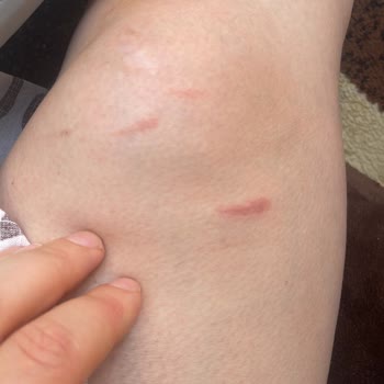 Ladyboss Güzellik Salonu Lazer Seansı Sonrası Bacaklarımda Yanıklar Oluştu