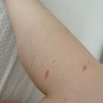 Ladyboss Güzellik Salonu Lazer Seansı Sonrası Bacaklarımda Yanıklar Oluştu