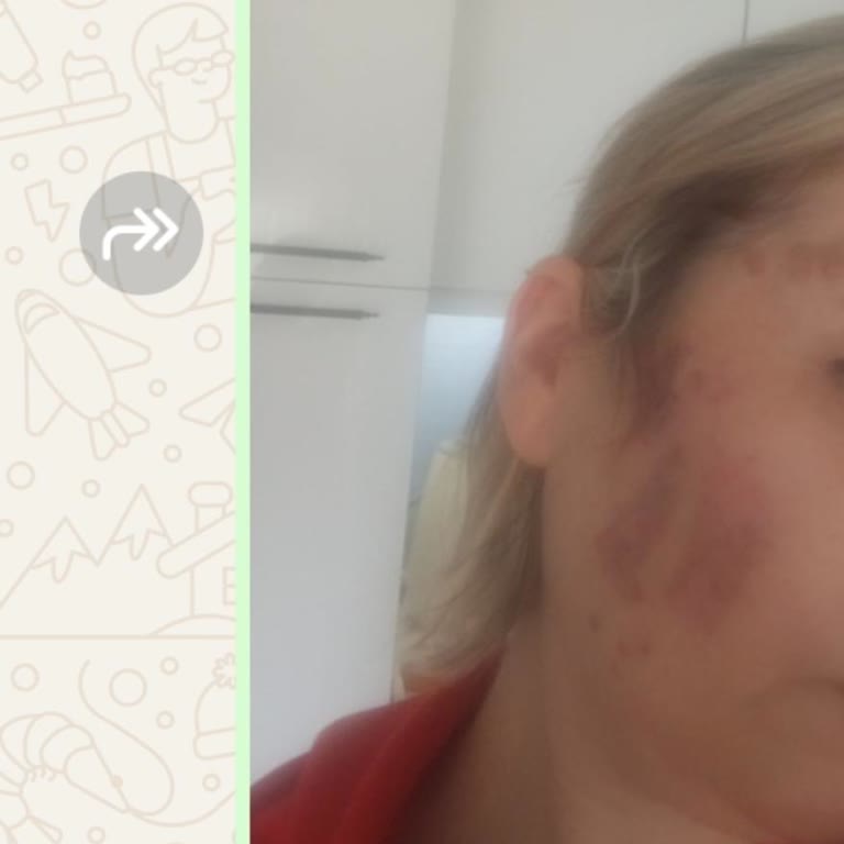 Güzellik Merkezinde Yapılan İşlem Sonrası Kalıcı Lekeler Ve Psikolojik Etkiler