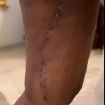 19 Mayıs Üniversitesi Hastanesi Üst Bacak Ameliyat Sonrası Dikişlerde Deformasyon