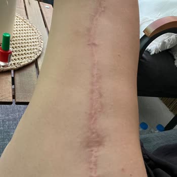 19 Mayıs Üniversitesi Hastanesi Üst Bacak Ameliyat Sonrası Dikişlerde Deformasyon