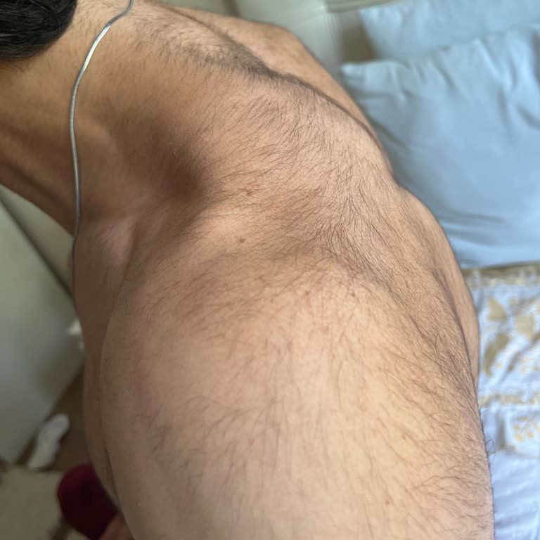 Lazer Epilasyon Sonrası Tüylerim Arttı, Param İade Edilmedi