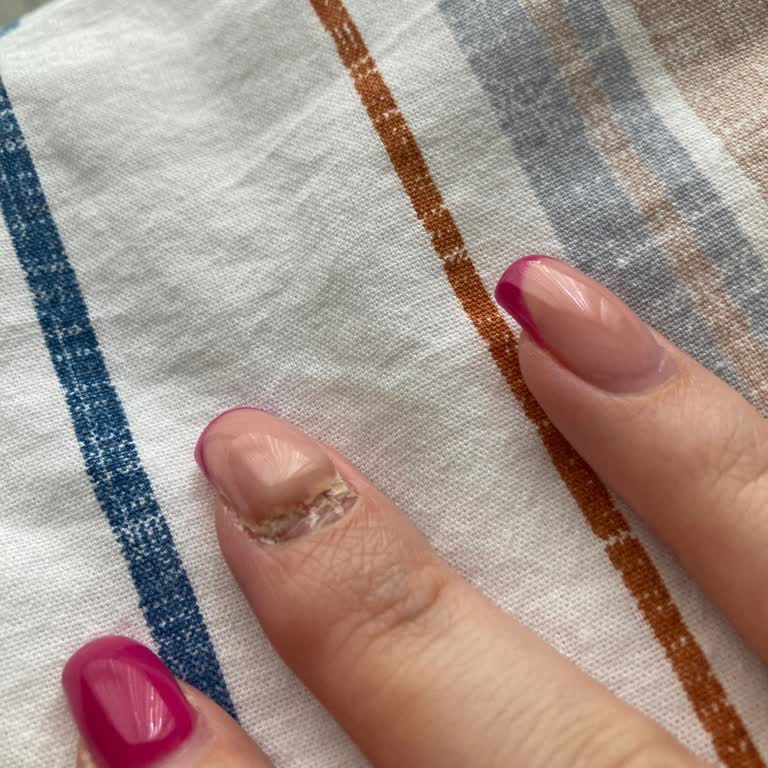 Hijyen Eksikliği Nedeniyle Tırnakta Mantar Oluştu