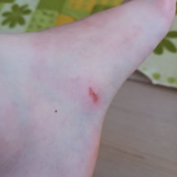 Aldığım Sandalet Ayağımı Yaraladı, Mağaza Değişim Yapmadı