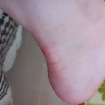 Aldığım Sandalet Ayağımı Yaraladı, Mağaza Değişim Yapmadı