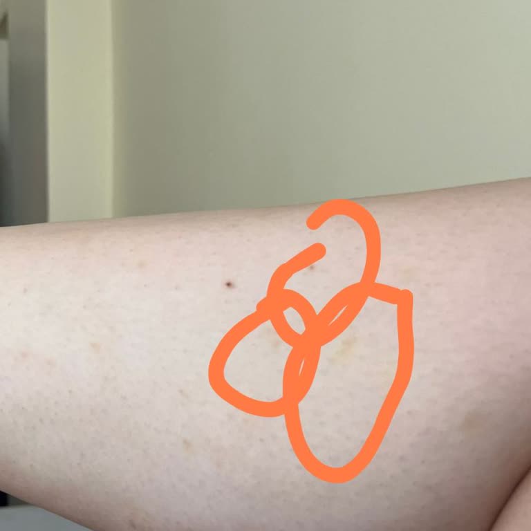 Lazer Tedavisinde Yanlış Uygulama Ve İletişim Sorunları Yaşadık