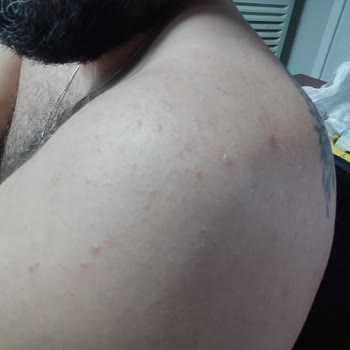 Veet Tüy Dökücü Krem Sonrası Ciltte Kalıcı Sivilce Sorunu