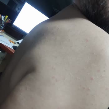 Veet Tüy Dökücü Krem Sonrası Ciltte Kalıcı Sivilce Sorunu