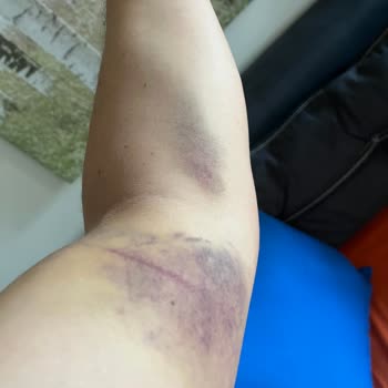 Kan Alımında Hata ve Anket Memnuniyeti Talebi