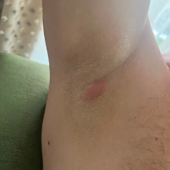 Rexona Roll On Sonrası Koltuk Altında Beze Ve Şiddetli Ağrı Yaşadık