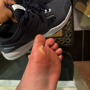 Yeni Alınan Ayakkabı Ciddi Şekilde Ayağımı Su Toplattı