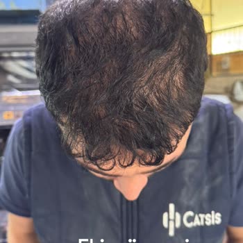 Saç Ekimi Sonrası İlgisizlik Ve Yetersiz Destek