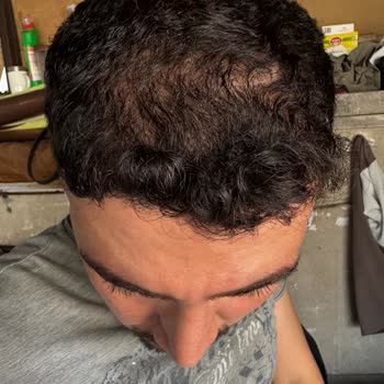 Saç Ekimi Sonrası İlgisizlik Ve Yetersiz Destek