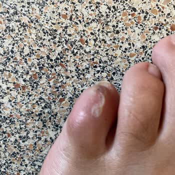 Aldığım Ayakkabı Ayağımda Yaralara Sebep Oldu