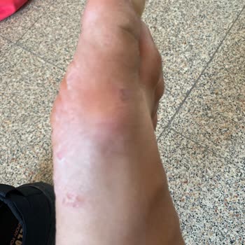 Aldığım Ayakkabı Ayağımda Yaralara Sebep Oldu