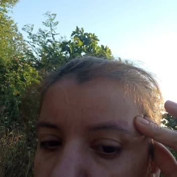 Kaş Ve Lazer İşlemlerinde Hayal Kırıklığı Yaşadım