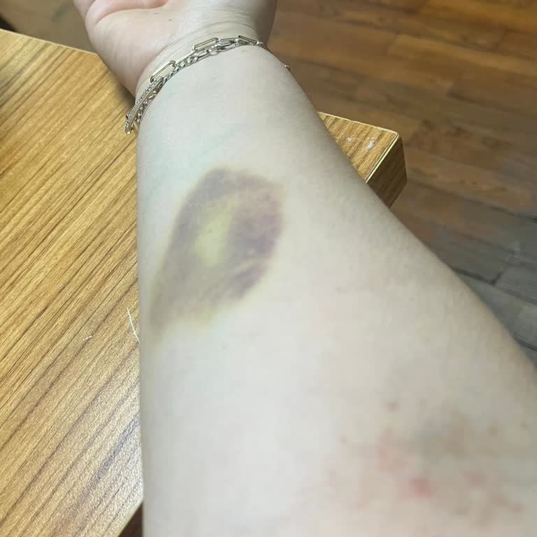 Tecrübesiz Hemşire Ve Olumsuz Kan Alma Deneyimi