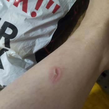 Seans Sonrası Yanık Oluştu İlgisizlik Mağduriyet Yarattı