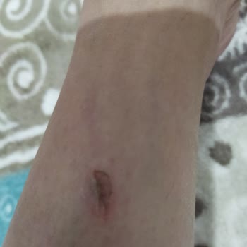 Seans Sonrası Yanık Oluştu İlgisizlik Mağduriyet Yarattı