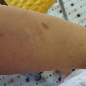 Seans Sonrası Yanık Oluştu İlgisizlik Mağduriyet Yarattı