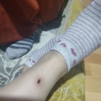 Seans Sonrası Yanık Oluştu İlgisizlik Mağduriyet Yarattı