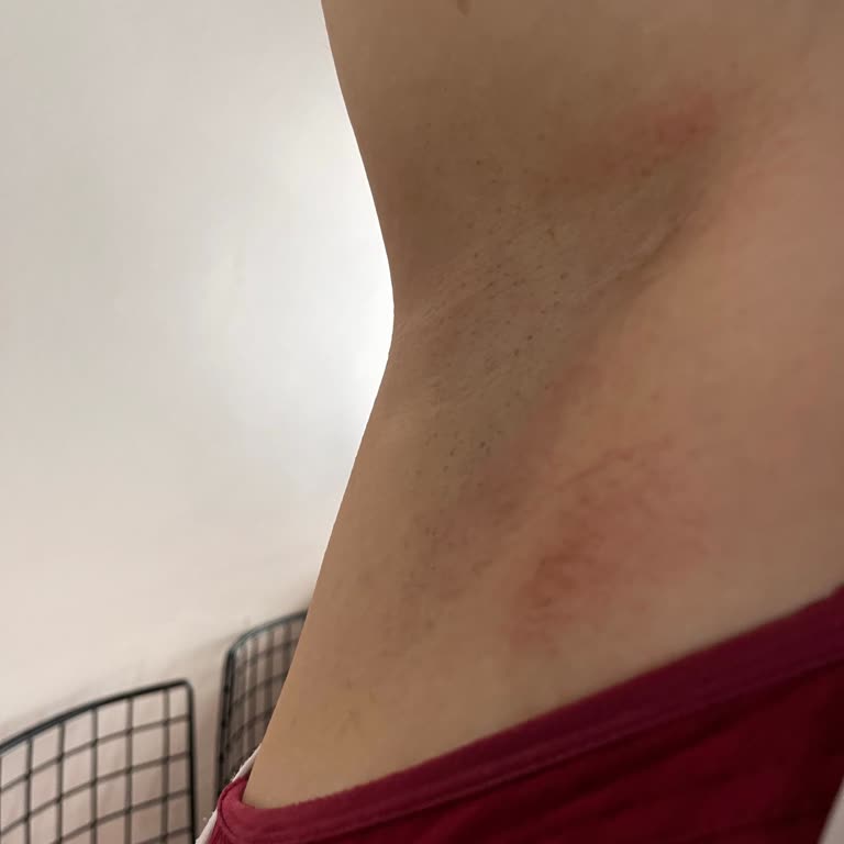 Agiss Tüy Dökücü Kullanımı Sonrası Ciltte Yanma Ve Mağduriyet