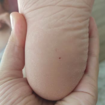 Ayakkabının İçinden Raptiye Çıktı, Kızım Yaralandı!