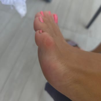 Ugg Sandalet Ayağımı Parçaladı Paramı Geri İstiyorum