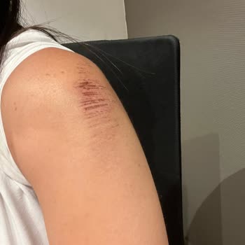 Yola Dökülen Yağ Nedeniyle Kaza Geçirdim, Mağduriyetim Giderilmedi