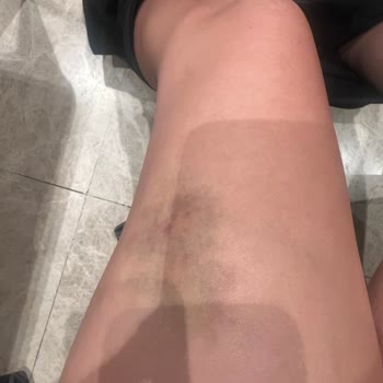 Yola Dökülen Yağ Nedeniyle Kaza Geçirdim, Mağduriyetim Giderilmedi