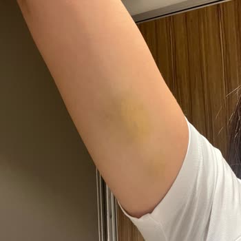 Yola Dökülen Yağ Nedeniyle Kaza Geçirdim, Mağduriyetim Giderilmedi