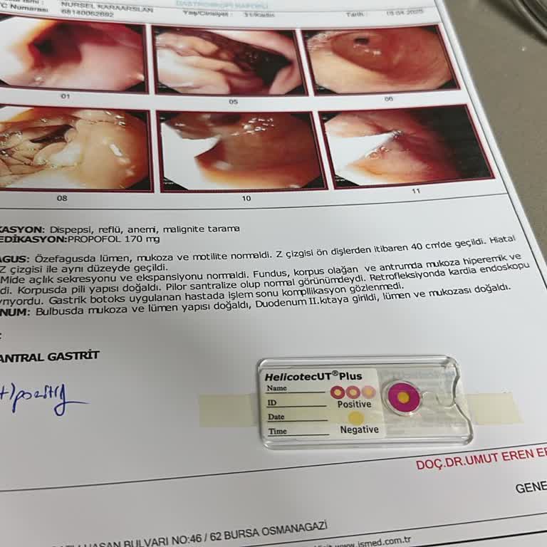 Mide Botoksu Sonrası Kilo Verememe Ve Hayal Kırıklığı