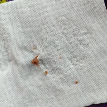 Yurdum Barbunya Pilaki İçinden Çıkan Sert Cisim Damağımı Yaraladı