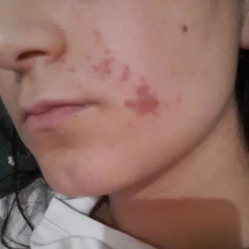 Cilt Beyazlatma İşlemi Sonrası Kalıcı Yara Ve İlgisiz Yaklaşım