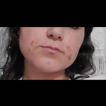 Cilt Beyazlatma İşlemi Sonrası Kalıcı Yara Ve İlgisiz Yaklaşım