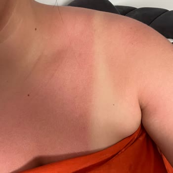 Bronzlaştırıcı Yağ Kullanımı Sonrası Ciddi Cilt Yanığı Yaşadım