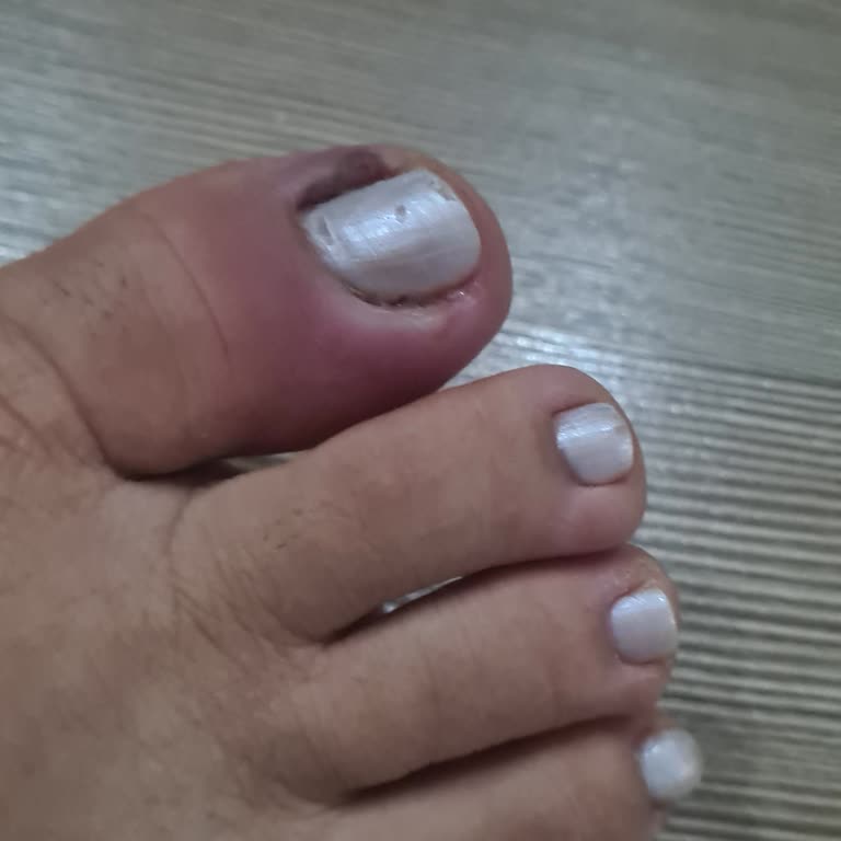 Pedikür Sonrası Enfeksiyon Ve Yetersiz Çözüm Önerisi