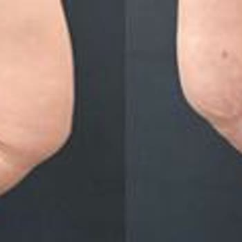 Başarısız Estetik Ameliyat Sonrası Yaşadığım Ciddi Mağduriyet