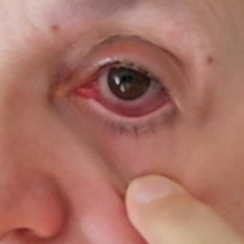 Sparx Bulaşık Tableti Gözümde Ciddi Yaralanmaya Sebep Oldu