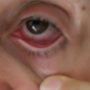 Sparx Bulaşık Tableti Gözümde Ciddi Yaralanmaya Sebep Oldu