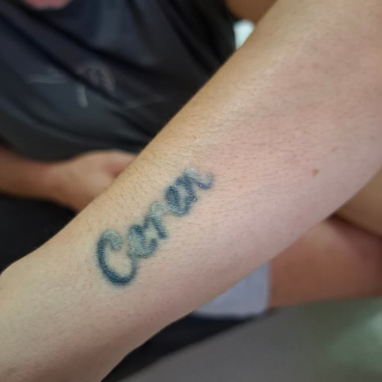 Dövme Silme İşleminde Yanık Ve İltihap Mağduriyeti