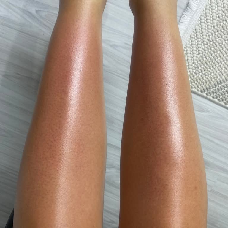 Eda Taşpınar Bronzlaştırıcı Yağ Cildimde Ciddi Yanıklara Sebep Oldu