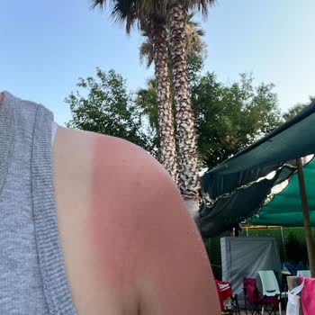 Aldığım Güneş Kremi Hiçbir Koruma Sağlamadı, Tatilimiz Mahvoldu