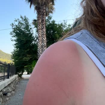 Pharmafer'dan Aldığımız Güneş Kremi Ciğer Gibi Yaktı