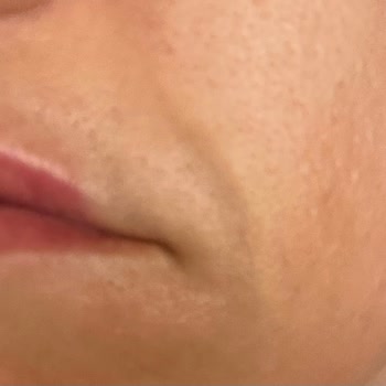 Yüz İşlemi Beklenenden Çok Daha Kısa Sürede Etkisini Kaybetti