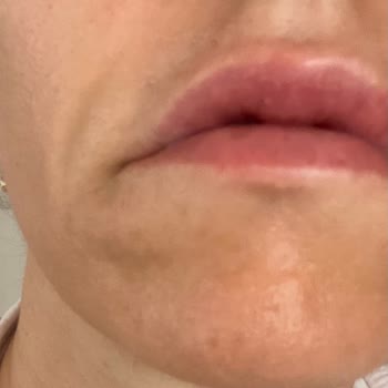 Yüz İşlemi Beklenenden Çok Daha Kısa Sürede Etkisini Kaybetti