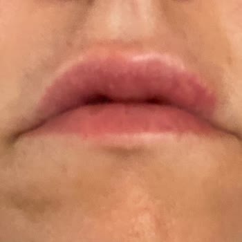 Yüz İşlemi Beklenenden Çok Daha Kısa Sürede Etkisini Kaybetti